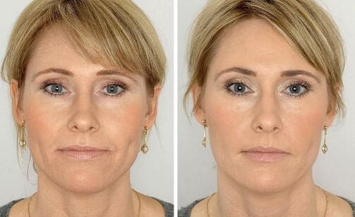 Photos before and after using the cream, experience of using Coralift Valerie from Paris